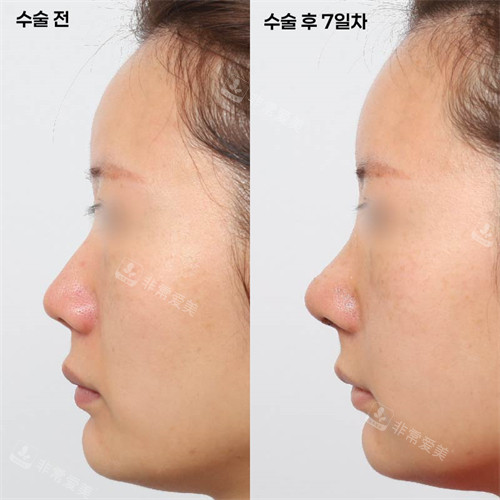 韩国新整形外科施术前后对比