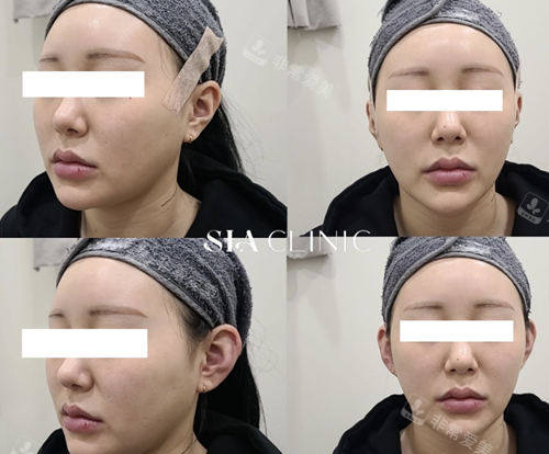 韩国SIA皮肤科抗衰前后对比
