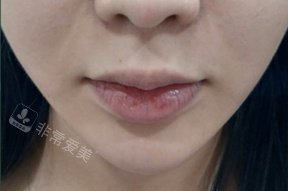 韩国greeny皮肤科唇部玻尿酸术前照片