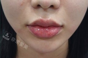 韩国greeny皮肤科唇部玻尿酸术后照片