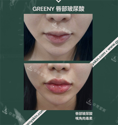 韩国greeny皮肤科唇部玻尿酸前后对比照片