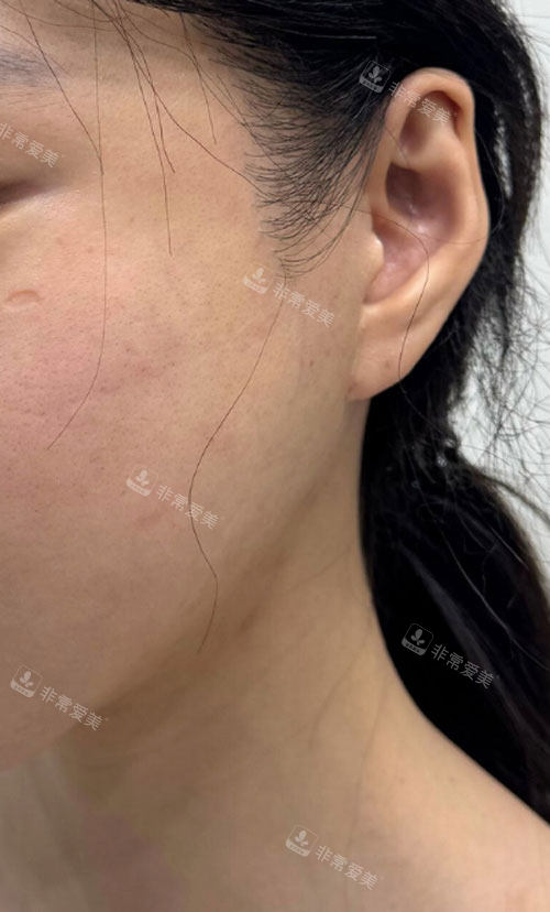 韩国greeny皮肤科耳垂填充前