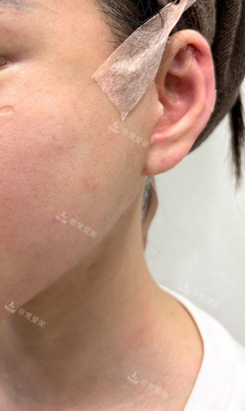 韩国greeny皮肤科耳垂填充后