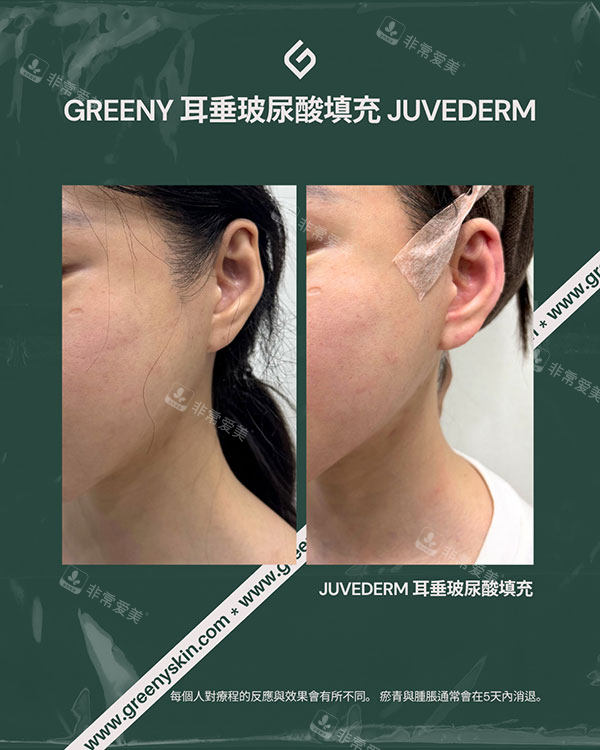 韩国greeny皮肤科耳垂填充对比图