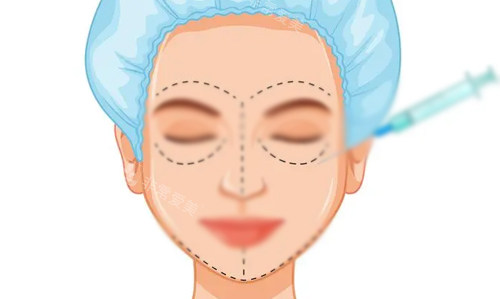 玻尿酸全脸填充展示 玻尿酸全脸填充展示