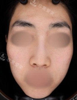 GreenY皮肤科对比图--后