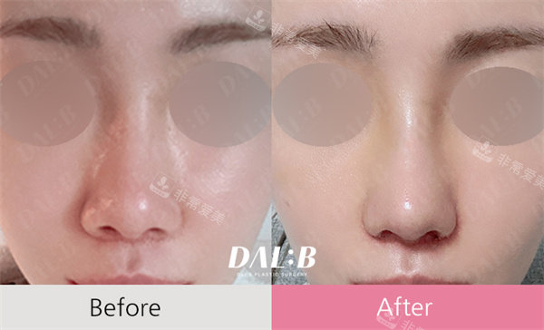 韩国Dal:B整形隆鼻前后对比图