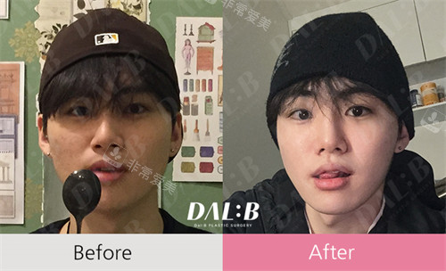 韩国Dal B整形外科整形前后
