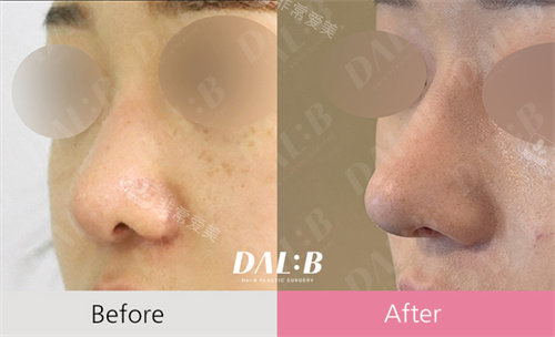 韩国Dal:B整形对比