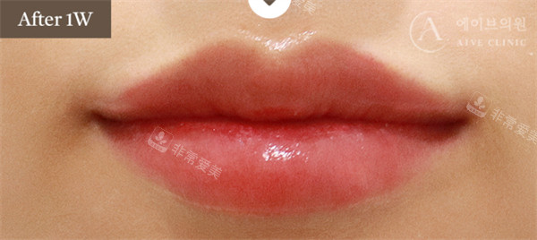 韩国Alive皮肤科丰唇后照片