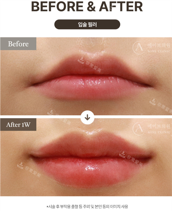 韩国Alive皮肤科丰唇前后对比图