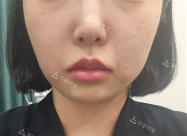 韩国greeny皮肤科面部提升术前图