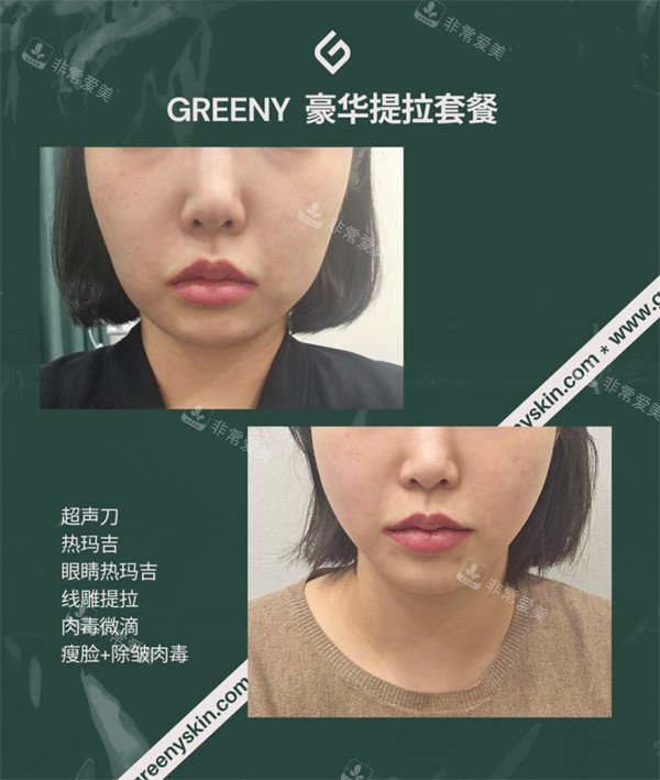 韩国greeny皮肤科面部提升对比图
