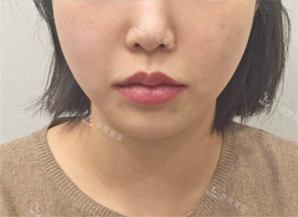 韩国greeny皮肤科面部提升术后图