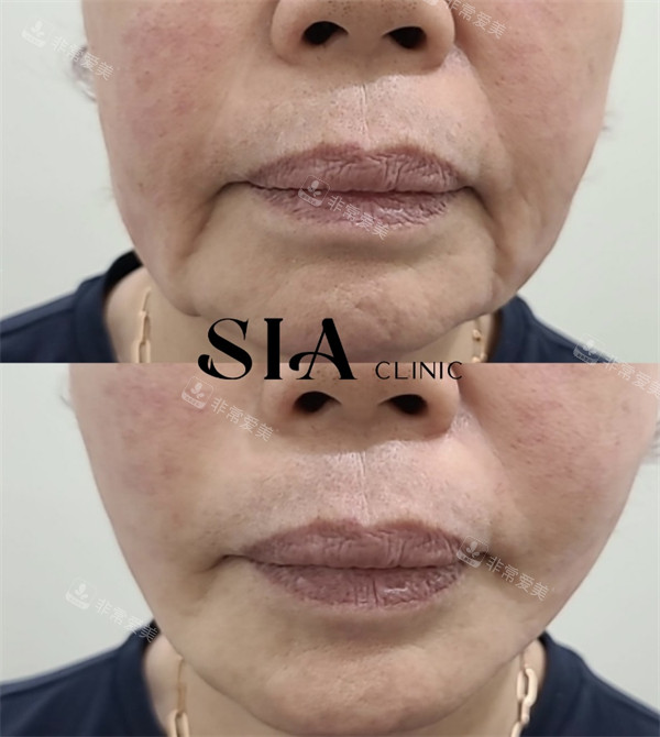 韩国SIA皮肤科面部提升对比图