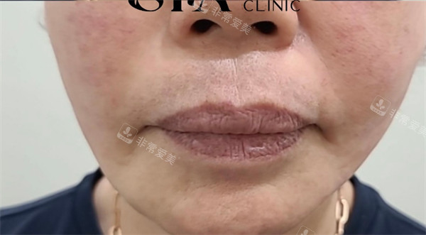 韩国SIA皮肤科面部提升术后图