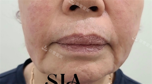 韩国SIA皮肤科面部提升术前图