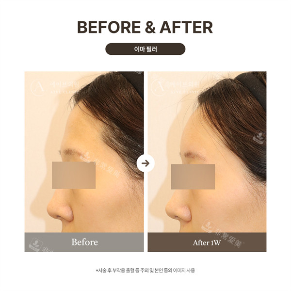 韩国aive皮肤科额头填充前后对比