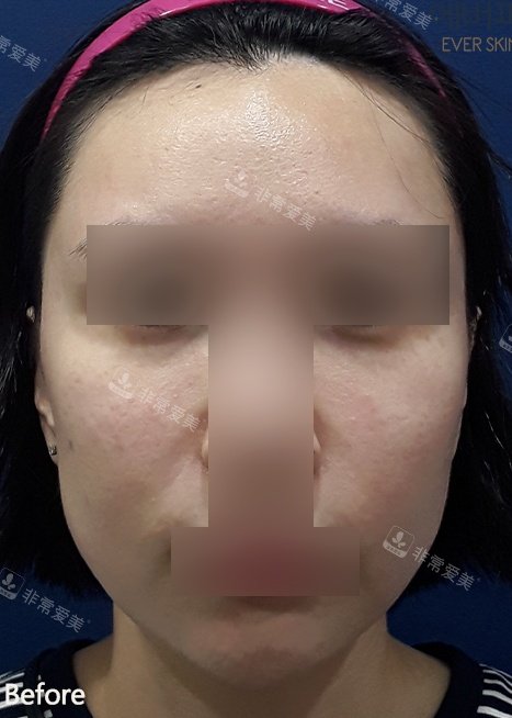 韓國ever皮膚科鈦提升+美版刀+填充+線提拉術(shù)前照片