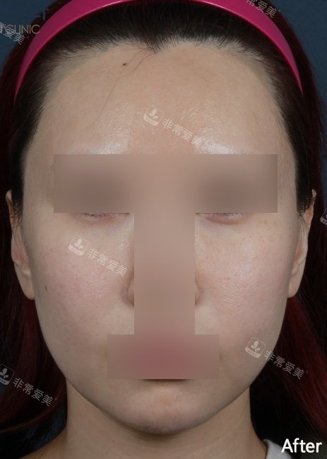 韓國ever皮膚科鈦提升+美版刀+填充+線提拉術(shù)后照片