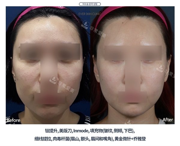 韓國ever皮膚科鈦提升+美版刀+填充+線提拉前后對比照片