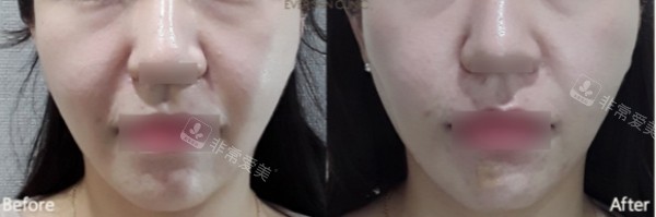 韓國(guó)ever皮膚科實(shí)例對(duì)比圖