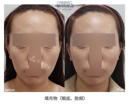 韩国Ever皮肤科眼底+脸颊填充真实术例