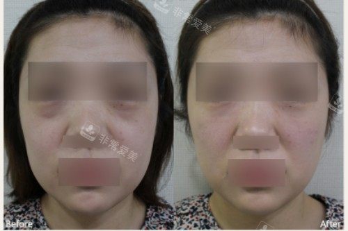 韓國ever皮膚科面部填充對(duì)比圖