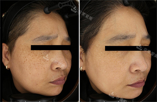 韩国夏恩皮肤科祛斑前后对比照