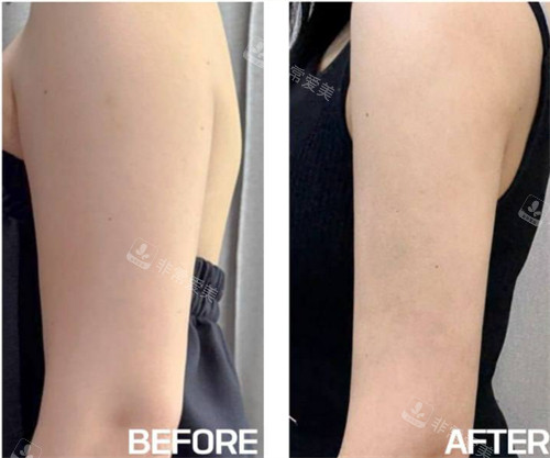 夏恩医院Ulfit+溶脂针+塑形针+复配针剂注射瘦胳膊