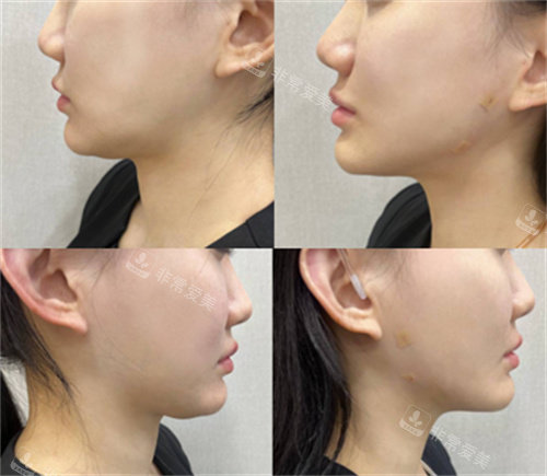 双下巴线雕+溶脂