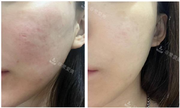 韩国夏恩医院juvelook+Air Dissector+疤痕玻尿酸治疗对比图
