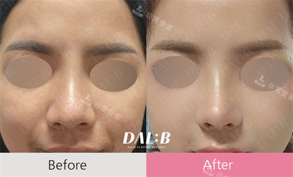 韩国Dal b整形鼻整形前后对比
