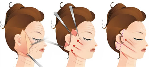 拉皮手術(shù)過程圖 拉皮手術(shù)過程圖