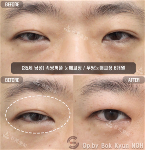 双眼皮手术对比图