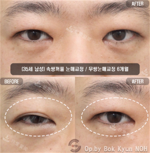 双眼皮手术对比