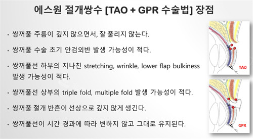 Sone整形外科tao+gpr双眼皮技术对比