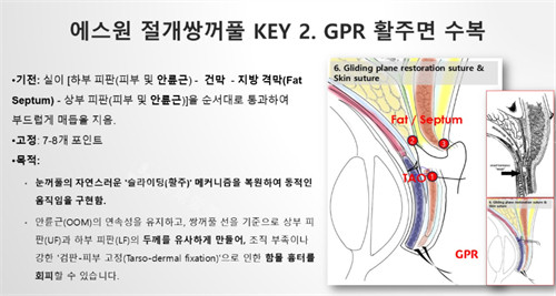 gpr双眼皮技术解析