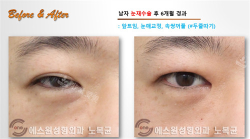 Sone整形外科男性双眼皮手术6个月前后对比