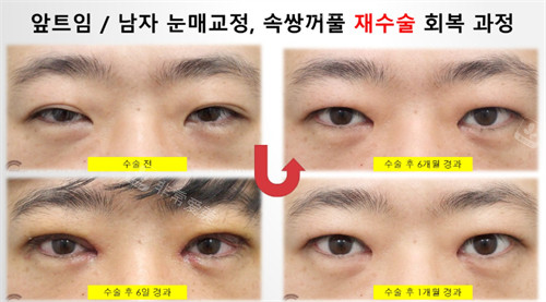 Sone整形外科双眼皮修复手术即刻和6个月后状态对比