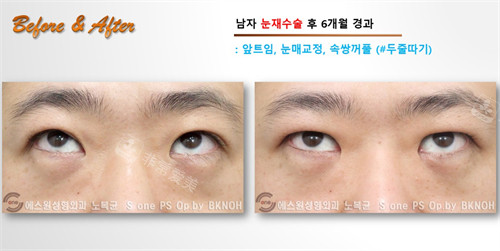 Sone整形外科双眼皮手术翻眼展示