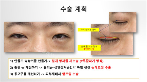 Sone整形外科双眼皮设计方案解析