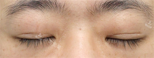 Sone整形外科双眼皮手术6个月后闭眼状态