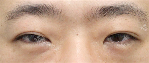 Sone整形外科双眼皮手术6个月后