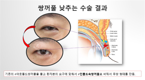 Sone整形外科双眼皮手术部位
