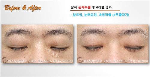 Sone整形外科双眼皮手术矫正后手术疤痕展示