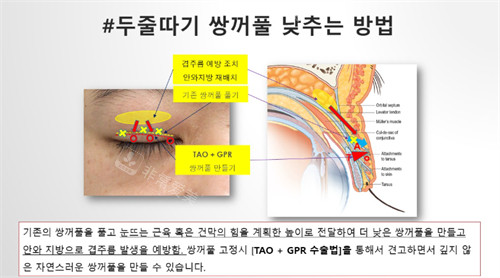Sone整形外科双眼皮技术解析