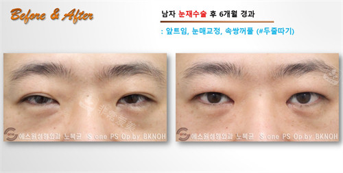 Sone整形外科双变单手术