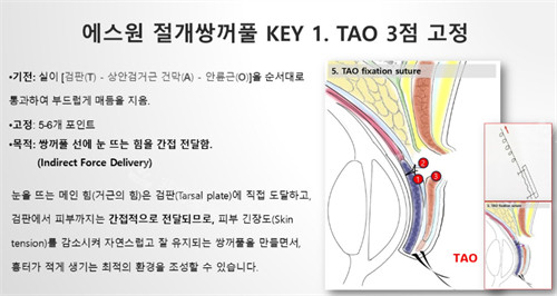 tao双眼皮原理解析