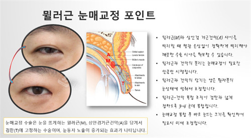 院长解析双眼皮技术难点